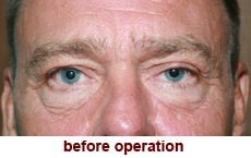 plastic-surgery-blepharoplasty